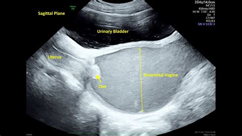 hematocolpos secondary to imperforate hymen ultrasound youtube