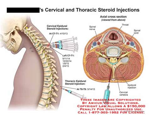 Amicus Illustration Of Amicusinjectionc7t1t8t9cervicalepidural