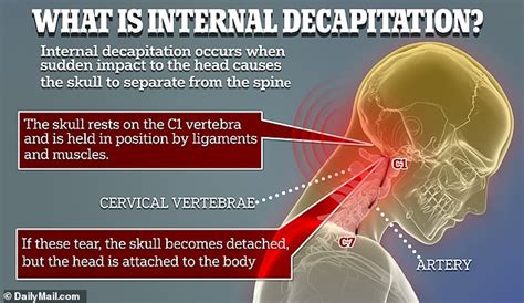 Doctors Re Attach Decapitated Boys Head After 12 Year Old Was Struck