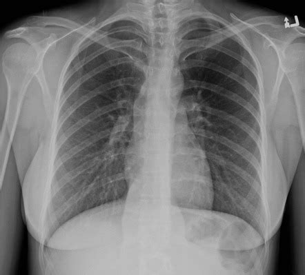 How do you apply the fundamental theorem of calculus when both integral bounds are a function of x. Paraspinal mass lesion on chest x-ray | Image ...
