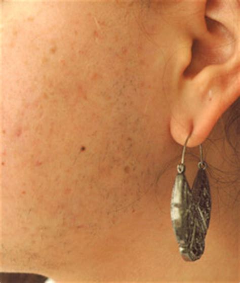 Jennifer geisman is a freelance writer and faithful beauty junkie living in los angeles. How Does Laser Hair Removal Work?