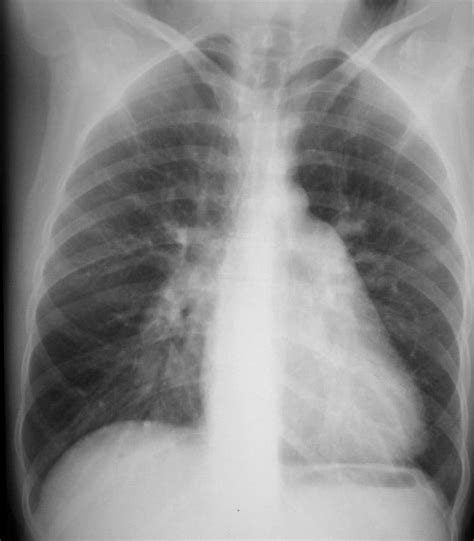 Cxr Pa Frontal And Cardiomegaly Heart