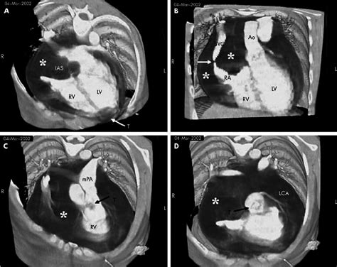 Volume Rendering Multidetector Row Computed Tomographic Mdct Images