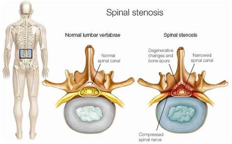 Lumbar Spinal Nerve Anatomy