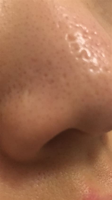 Nose Scars Could These Get Better Scar Treatments Forum