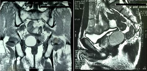 Pelvic Epidermoid Cyst A Rare Cause Of Lower Urinary Tract Symptoms