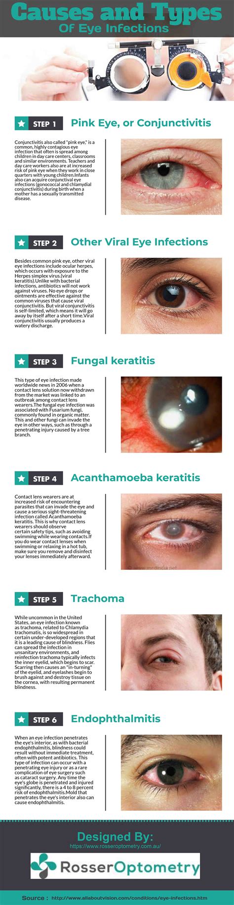 Infographics Infographic Eye Infections Pink Eyes