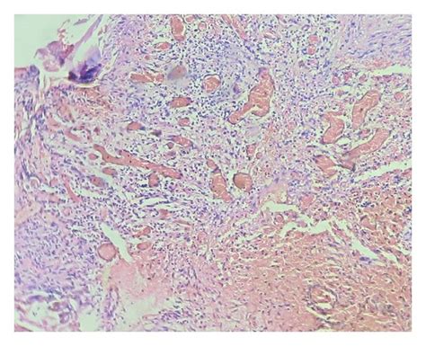 Fibrous Connective Tissue Showing Numerous Thin Walled Vascular Spaces