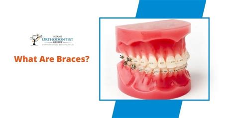 Dental Braces Types Care What To Expect Miami Orthodontist Group