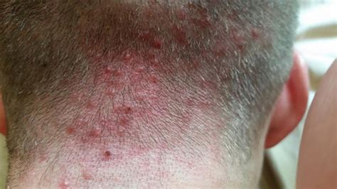 How To Prevent Folliculitis After Hair Transplant Best Hairstyles