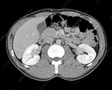 Normal Abdominal Organs Ct Scan Stock Image C0166686 Science