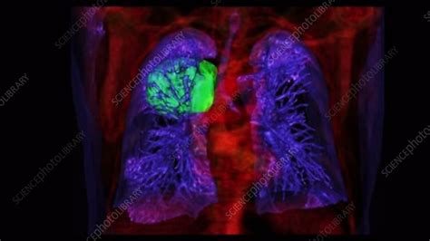Lung Cancer Ct Scan Stock Video Clip K0051517 Science Photo Library