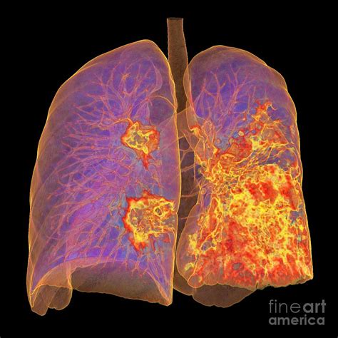 Lungs Affected By Covid 19 Atypical Pneumonia Photograph By K H Fung