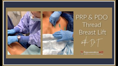 Non Surgical Breast Lift With Prp And Pdo Threads Youtube