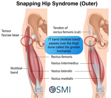 Snapping Hip Syndrome The Orthopedic And Sports Medicine Institute In