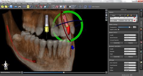 In 2009,beech house dental practice achieved the bda good practice award. Guided Implants Treatment Planning Software Blue Sky Plan ...
