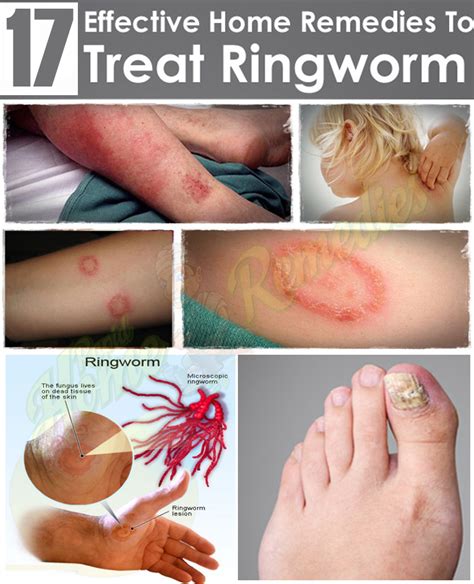 Ringworm In Kids Ways To Prevent And Treat Them