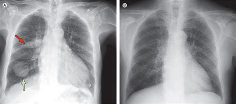 Phantom Tumour Of The Lung The Lancet