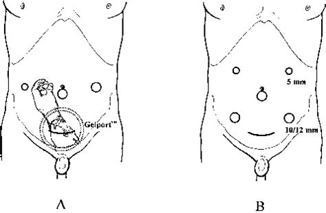 Trocar And Device Placement In A Hand Assisted Laparoscopic Total Download Scientific Diagram