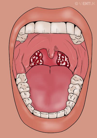 Tonsillectomy Taking Out Your Tonsils Because Of Repeated Infections