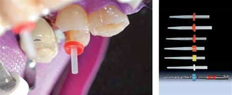 38 Clinical Methods With Glass Fiber Posts Pocket Dentistry