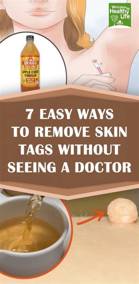 7 easy ways to remove skin tags without seeing a doctor skin tag removal skin tag coconut