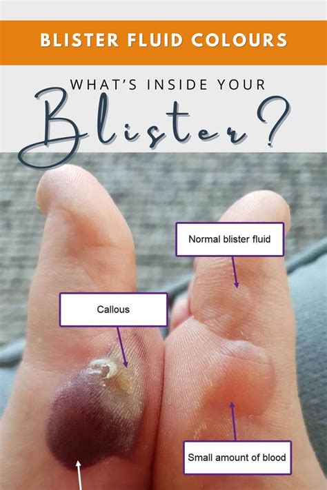 Blister Fluid Colours Whats Inside Your Blister Blister Treatment