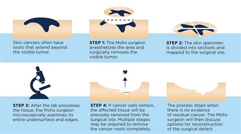 About Mohs Surgery Skin Surgery Center Of Oklahoma