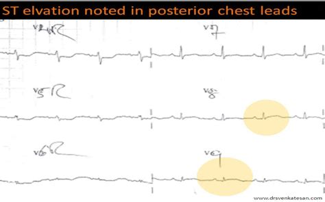 Isolated Posterior Mi Drsvenkatesan Md