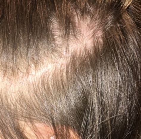 Really Red Scalp Dermatology Forums Patient