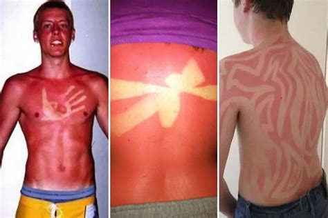 Had A Bit Too Much Sun These Sunburnt People Will Make You Feel Better About Your Own Suncream