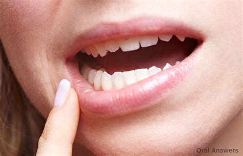 Wisdom Teeth Removal Swelling