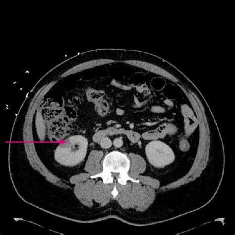 Ct Abdomenpelvis With Iv Contrast With Splenic Infarcts Download
