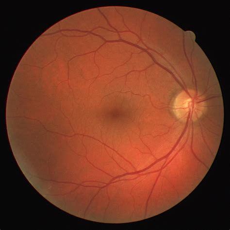 Eye Fundus Images Of Different Ophthalmic Conditions Download