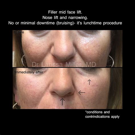 Lunchtime Face Rejuvenation Before And After Vista Clinic Melbourne