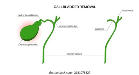 Cholecystectomy Concept Gallbladder Removal Procedure Inflammation
