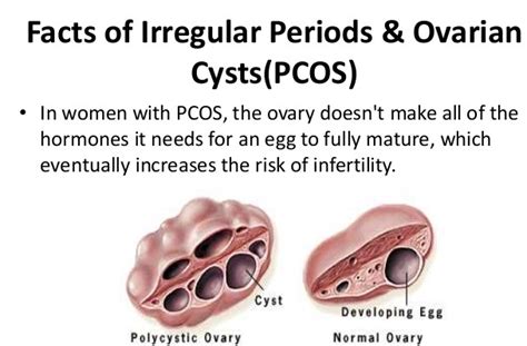 Ibrahim Online Understanding Polycystic Ovarian Syndrome