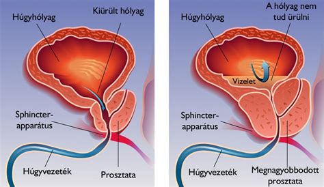 a prostatitis legjobb módszereinek kezelése)