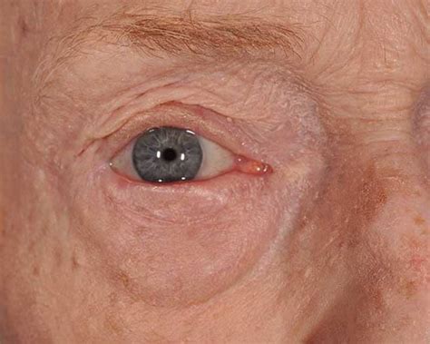 Eyelid Cancer Treatment In Mo Eyelid Cancer Reconstruction In Mo
