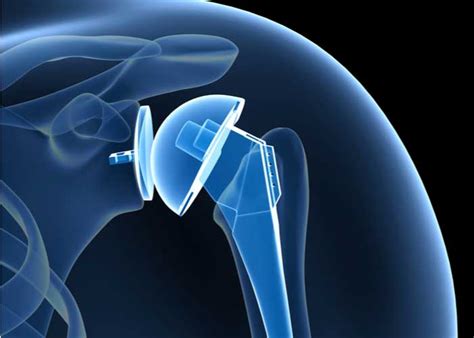 Total Shoulder Replacement Arthroplasty Orthopedic Shoulder Doctor