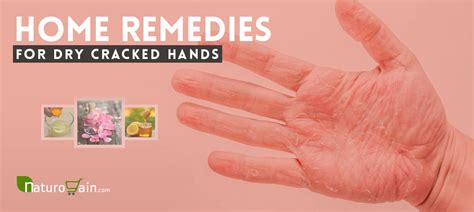 10 Best Home Remedies For Dry Cracked Hands That Work Naturally