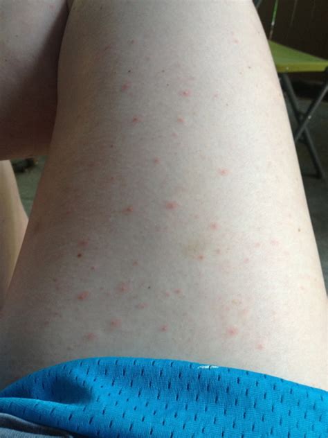 What Are These Red Dots On My Inner Thigh Picture