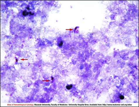 Plasmodium Falciparum Cell Atlas Of Haematological Cytology