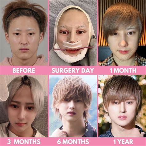 Japanese Male Patient Had Makeover Plastic Surgeries At Id Hospital In