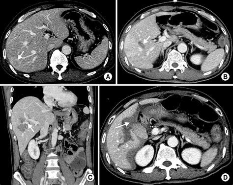 Serial Changes Of Intrahepatic Laceration And Hematoma After