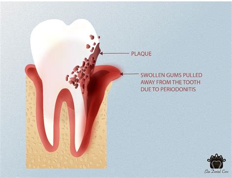 Why Is It Important To Treat Periodontitis Disease Elite Dental Care