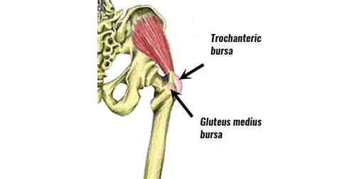 Hip Bursitis Trochanteric Bursitis Symptoms Causes Treatment