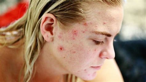 Rare Skin Diseases That People Find Hard To Talk About Woms