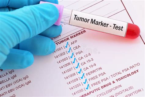Blood Sample For Tumor Marker Test Stock Image Image Of Laboratory
