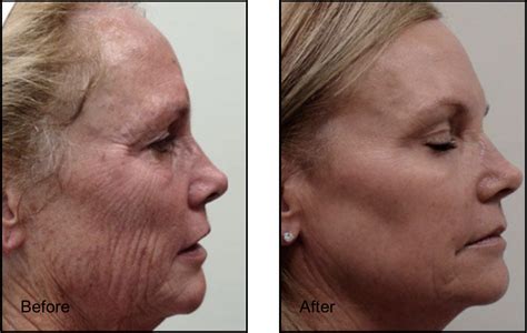 Fractional Co Laser Resurfacing In Beverly Hills Ca